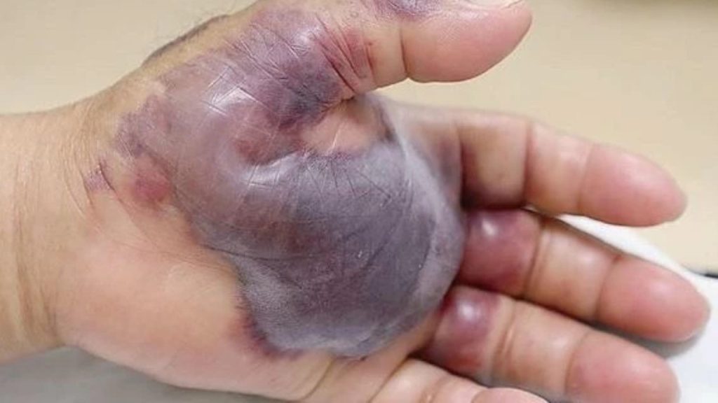 Sağlık Bakanlığı’ndan ‘vibrio bakterisi’ açıklaması